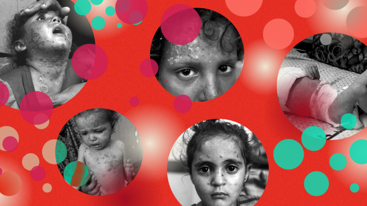 Diseases speading among people in Gaza